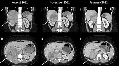 Case Report: Response to ipilimumab and nivolumab in a patient with adrenocortical carcinoma